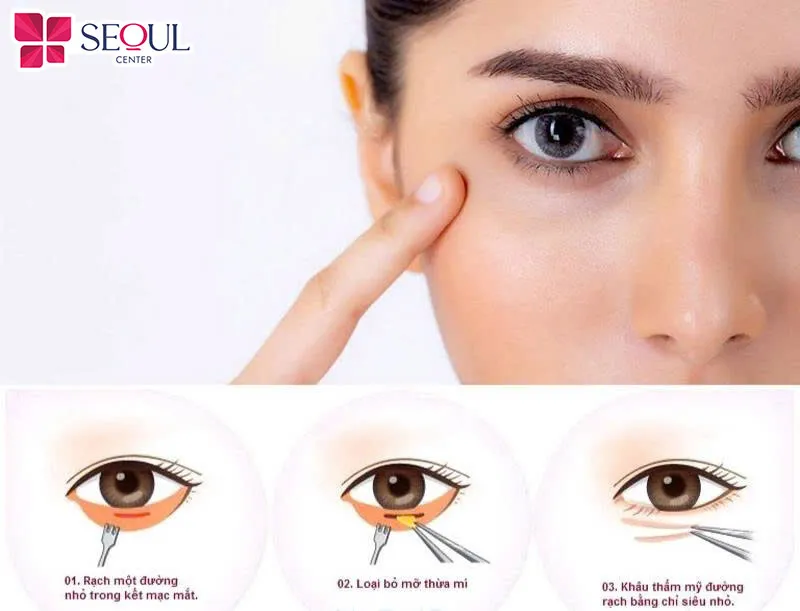 Cắt mí dưới sẽ giúp loại bỏ những phần da chùng nhão, mỡ thừa tích tụ giúp đôi mắt trở nên tươi sáng hơn