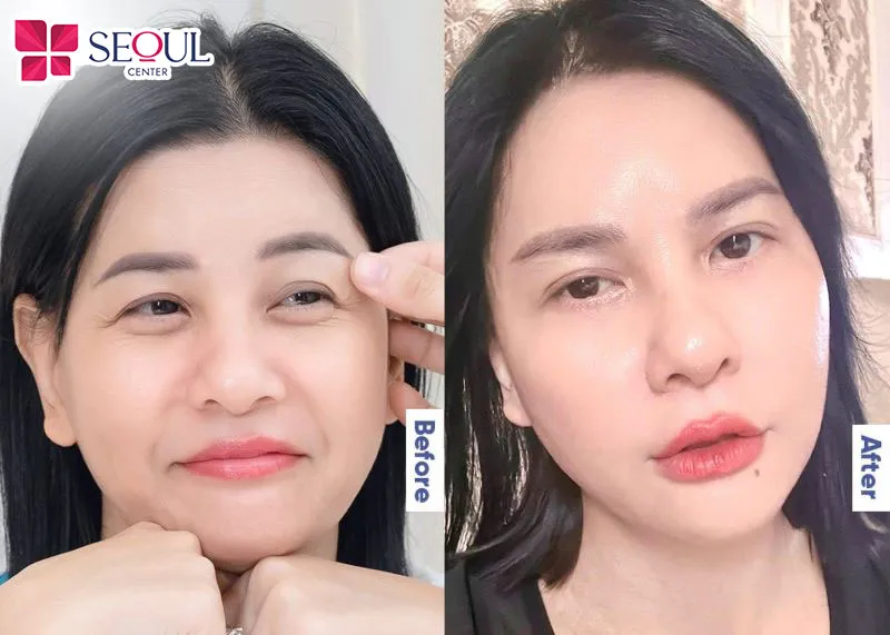 Hình ảnh khách hàng trước và sau khi đến Seoul Center thực hiện cắt mí dưới