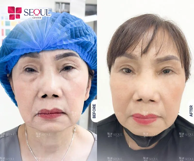 Đối với những người có cơ địa nhanh lành, mí mắt sau phẫu thuật khi hồi phục sẽ trở nên căng mịn, mềm mại 