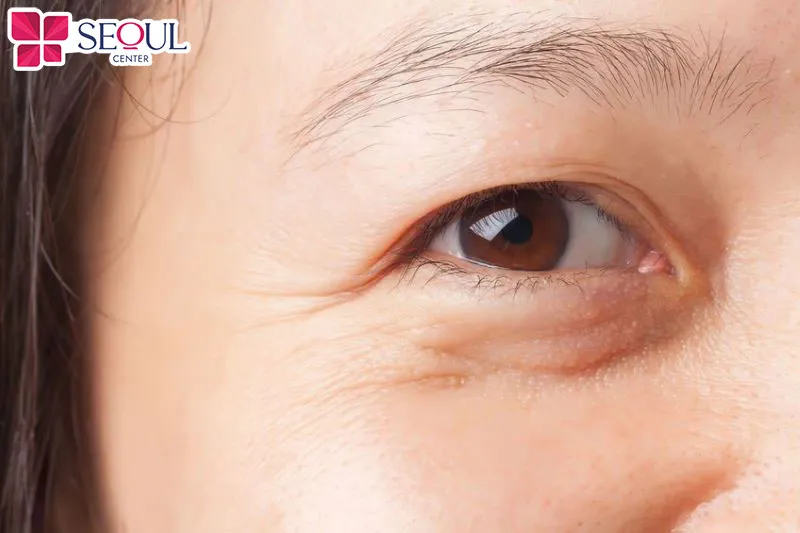 Cắt mí dưới trở thành giải pháp lý tưởng giúp trẻ hóa đôi mắt được nhiều người lựa chọn khi đã có dấu hiệu lão hóa ở vùng mắt 
