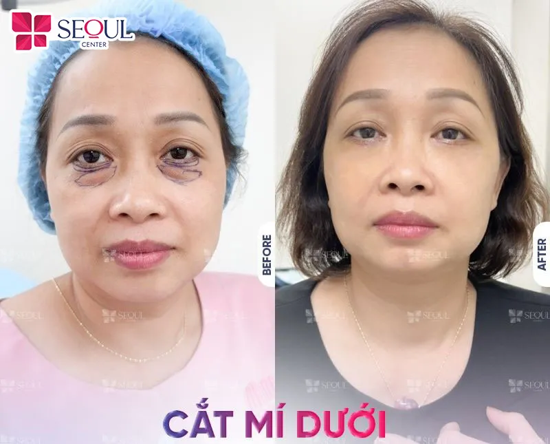 Cắt mí dưới sẽ giúp vùng da trở nên phẳng mịn, khiến gương mặt trông trẻ trung hơn nhiều 