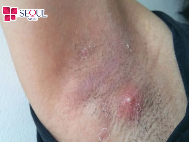 Nách bị viêm lỗ chân lông gây ngứa rát đau khó chịu sau khi cạo lông không đúng cách