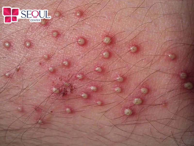 Tỉa lông vùng kín không đúng cách, không đảm bảo vệ sinh có thể gây kích ứng, mẩn đỏ, viêm nang lông da “cô bé”