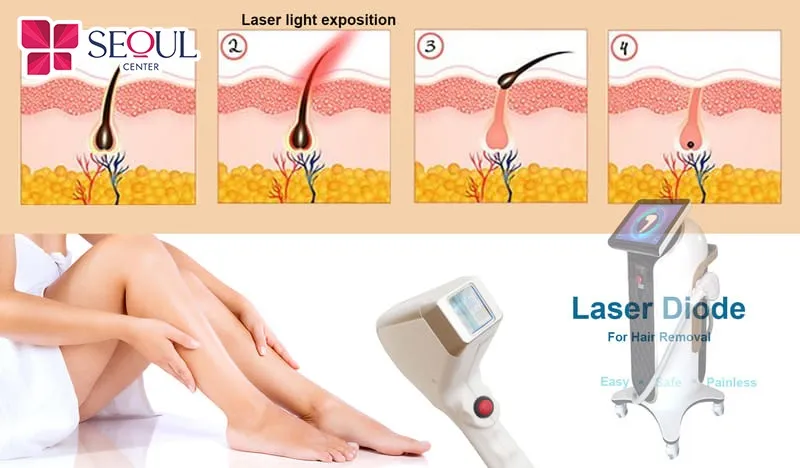 Công nghệ Laser Diode được đánh giá có hiệu quả triệt lông tốt
