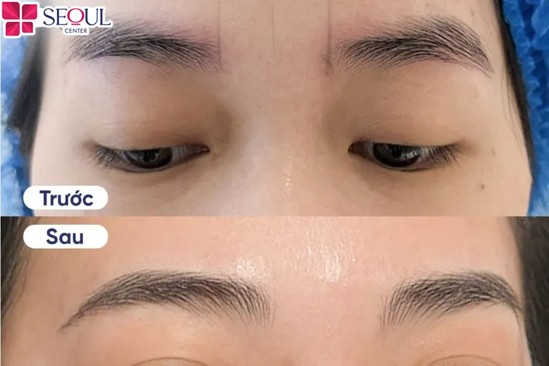 Hình ảnh trước và sau khi điêu khắc chân mày 6D của khách hàng tại Thẩm mỹ viện Seoul Center