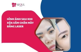 Hình ảnh sau khi xóa xăm chân mày bằng laser