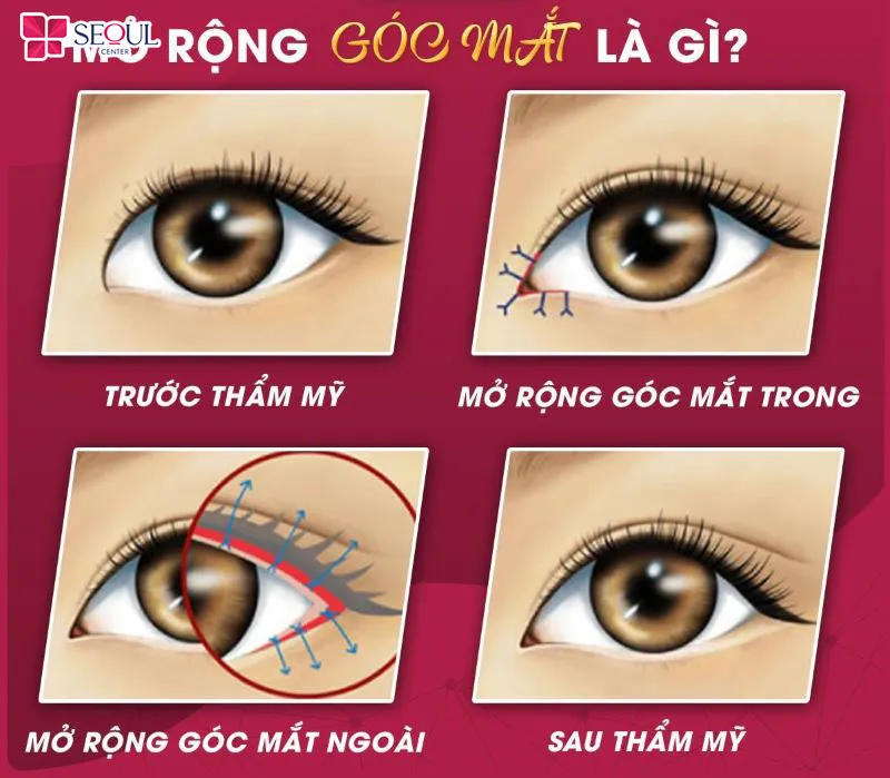 Mở góc mắt ngoài giúp giải quyết tình trạng mắt ngắn, hẹp chiều ngang ở đuôi mắt
