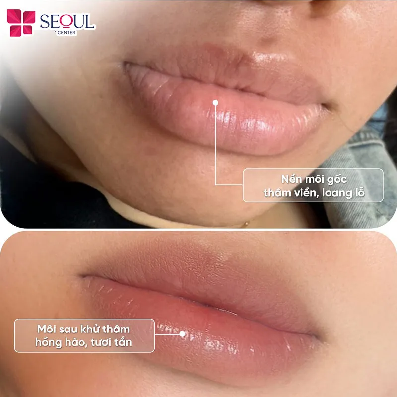 Khử thâm môi trước khi phun là giải pháp giúp môi lên màu đẹp, chuẩn sắc sau phun 