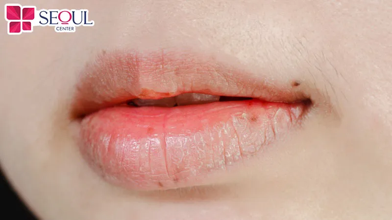 Phun môi phủ bóng collagen phù hợp cho những người có môi thâm xỉn màu, khô và nứt nẻ 