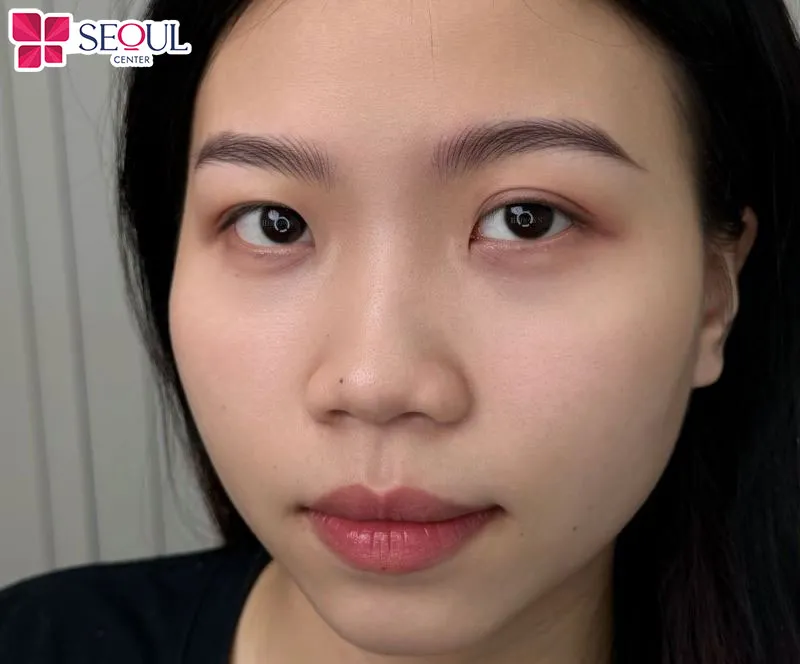 Mí mắt trở về vị trí tự nhiên, khôi phục sự tự tin cho khách hàng và nâng tầm diện mạo từ đôi mắt