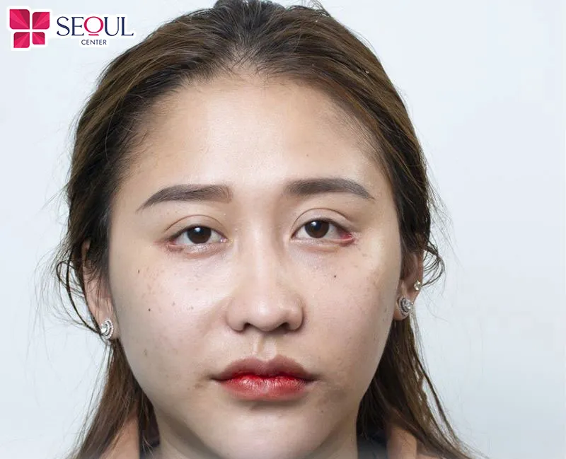 Phương pháp này không chỉ giúp phục hồi mà còn cải thiện chức năng bảo vệ mắt 