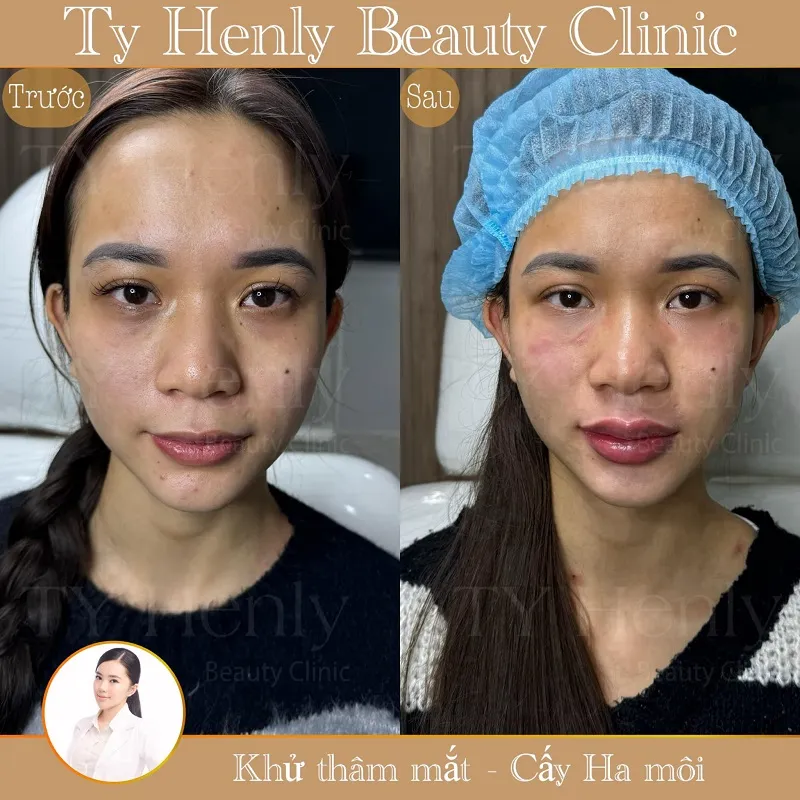 Khách hàng khử thâm mắt và cấy HA môi thành công tại Ty Henly Beauty Clinic