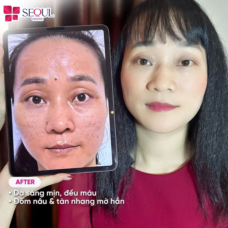 Da khách hàng đã được cải thiện các đốm nâu, tàn nhang sau khi điều trị tại Seoul Center