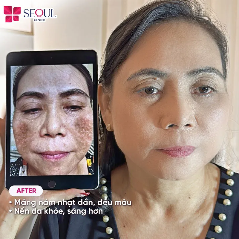 Chị khách trẻ ra nhiều tuổi sau khi điều trị nám tại Seoul Center