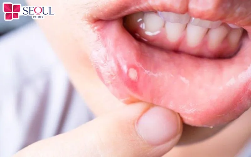 Nếu môi có vết thương hở, có mụn nước, hoặc đang lở loét thì không nên bôi thuốc ủ tê