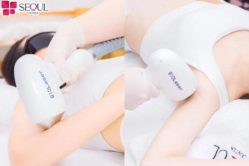 Dịch vụ triệt lông vĩnh viễn của Seoul Center sử dụng công nghệ Diode Laser tiên tiến