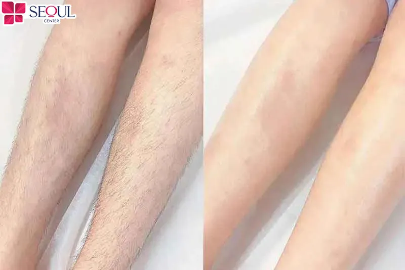 Hình ảnh trước và sau khi triệt lông của khách hàng tại Thẩm mỹ viện Seoul Center Đà Nẵng
