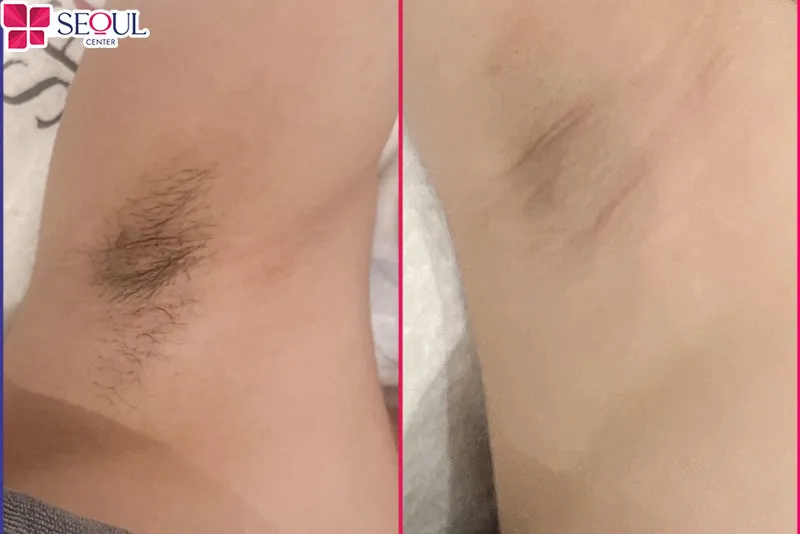 Vùng nách dần sáng hơn sau khi triệt lông tại Thẩm mỹ viện Seoul Center Đà Nẵng