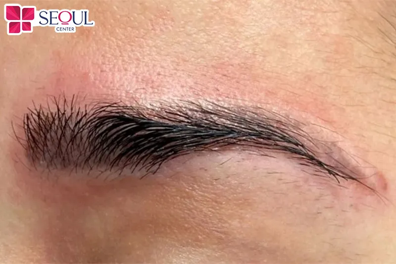 Nếu chân mày sau phun sưng tấy nặng, đau nhức dai dẳng thì đây là dấu hiệu bất thường