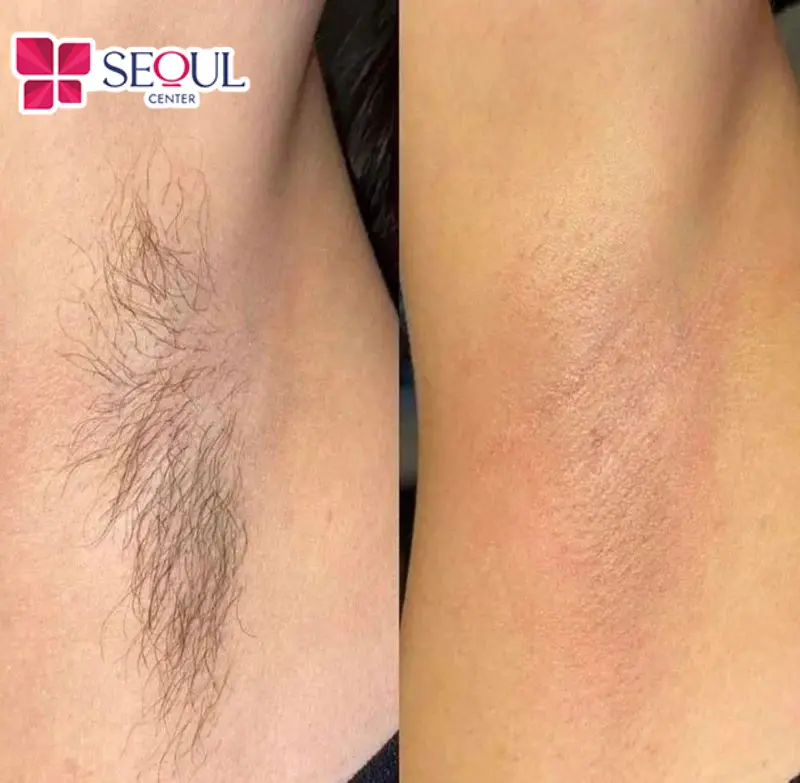 Mang lại vùng da nách sạch sẽ, các lớp lông cứng dày đã được loại bỏ và giúp giảm các vi khuẩn gây mùi hôi