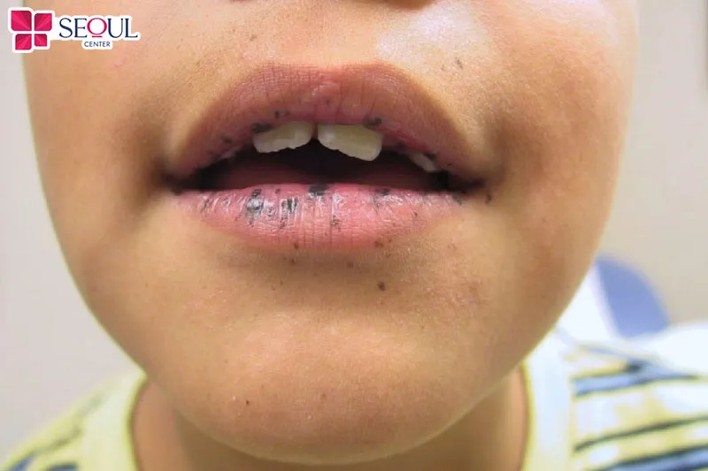 Các đốm đen sau phun môi rất khó bị phát hiện khi môi chưa bong