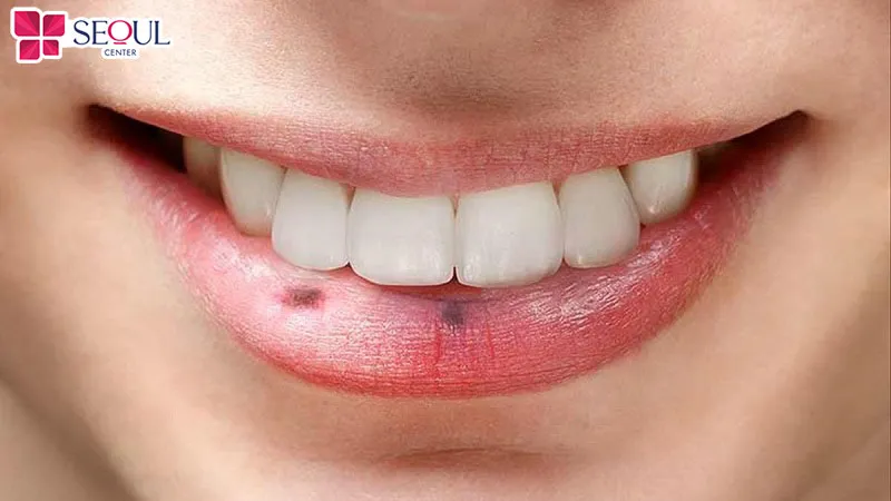 Nếu môi có sẵn nốt ruồi có thể là nguyên nhân khiến môi bị đốm đen sau phun