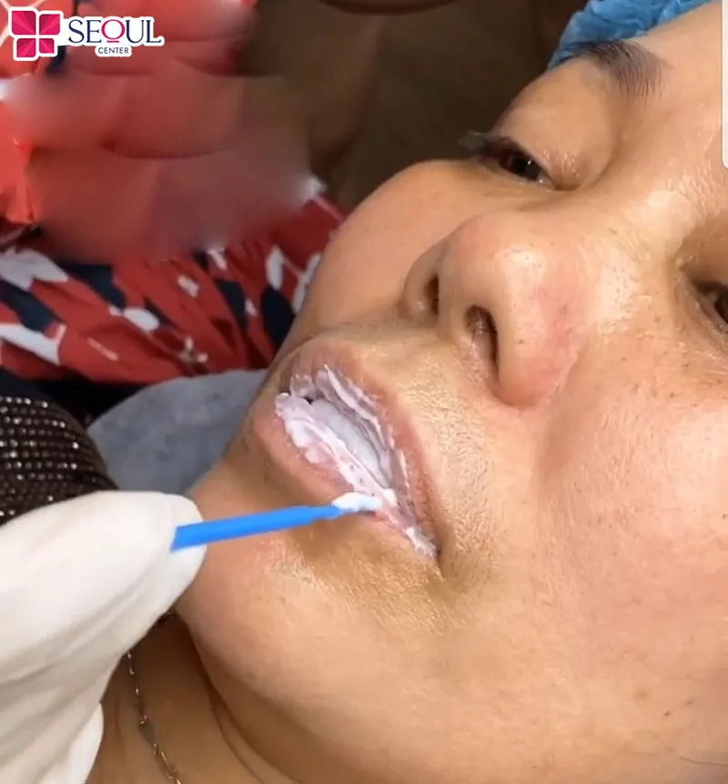 Ủ tê môi quá liều, để quá lâu trên môi có thể khiến môi xuất hiện đốm đen sau khi phun