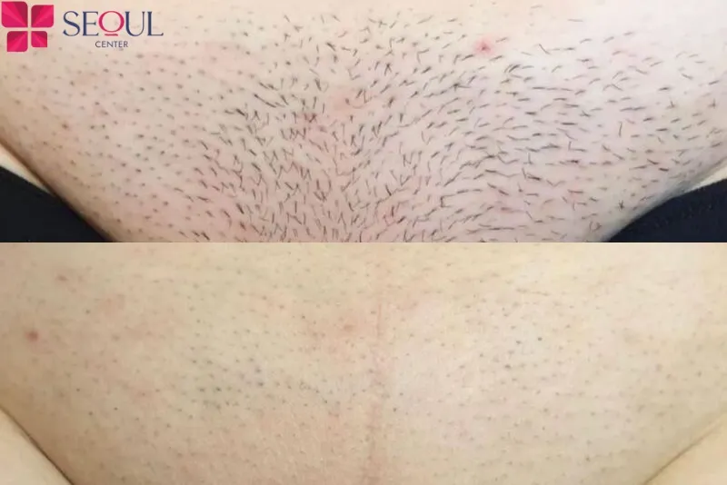 Khách hàng lựa chọn triệt lông vùng kín tại Thẩm mỹ viện Seoul Center