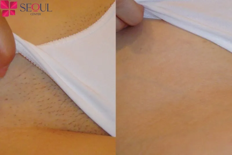 Vùng da trở nên mịn màng hơn sau khi triệt lông vùng kín