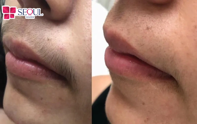 Hình ảnh trước và sau khi khách hàng tới Seoul Center triệt ria mép