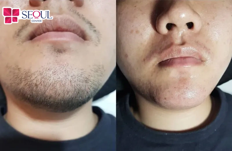 Khách hàng sau liệu trình triệt râu vài buổi tại thẩm mỹ viện Seoul Center