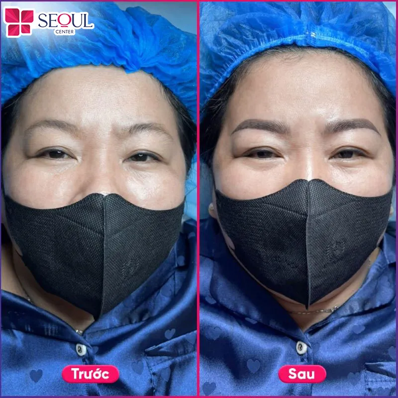 Hình ảnh chỉnh sửa dáng mày bị trổ xanh trổ đỏ, giúp chân mày trông đẹp tự nhiên và cân đối với gương mặt