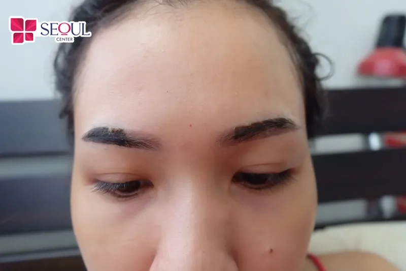 Khi vùng da mày được ổn định, bề mặt da se lại tự nhiên và bắt đầu không cũng như không còn tiết dịch thì hãy bôi lớp thuốc mỡ thật mỏng