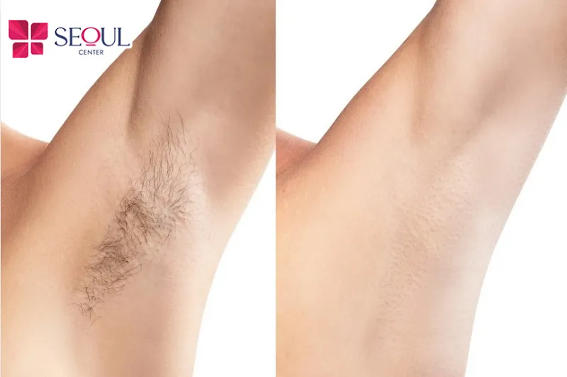 Triệt lông bằng công nghệ hiện đại như laser được đánh giá an toàn, hiệu quả cao khi được thực hiện bởi bác sĩ/chuyên viên giỏi tại cơ sở uy tín