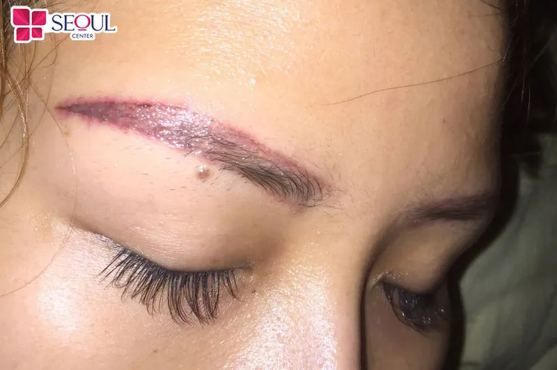 Sau xóa xăm chân mày mà vẫn còn tình trạng sưng đỏ lâu ngày là biểu hiện bất thường