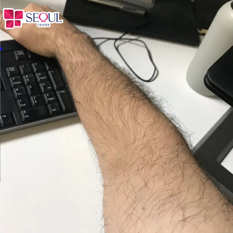 Lông tay có thể được chia thành nhiều kiểu như lông mọc dày rậm, xoăn hoặc có màu trắng ngả vàng