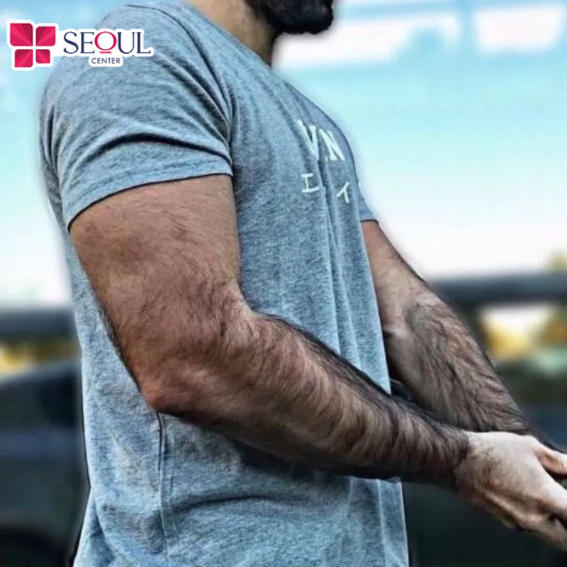 Lông tay nhiều là giàu? Thực tế lông mọc nhiều do yếu tố di truyền, bệnh lý hoặc hormone tăng trưởng mạnh