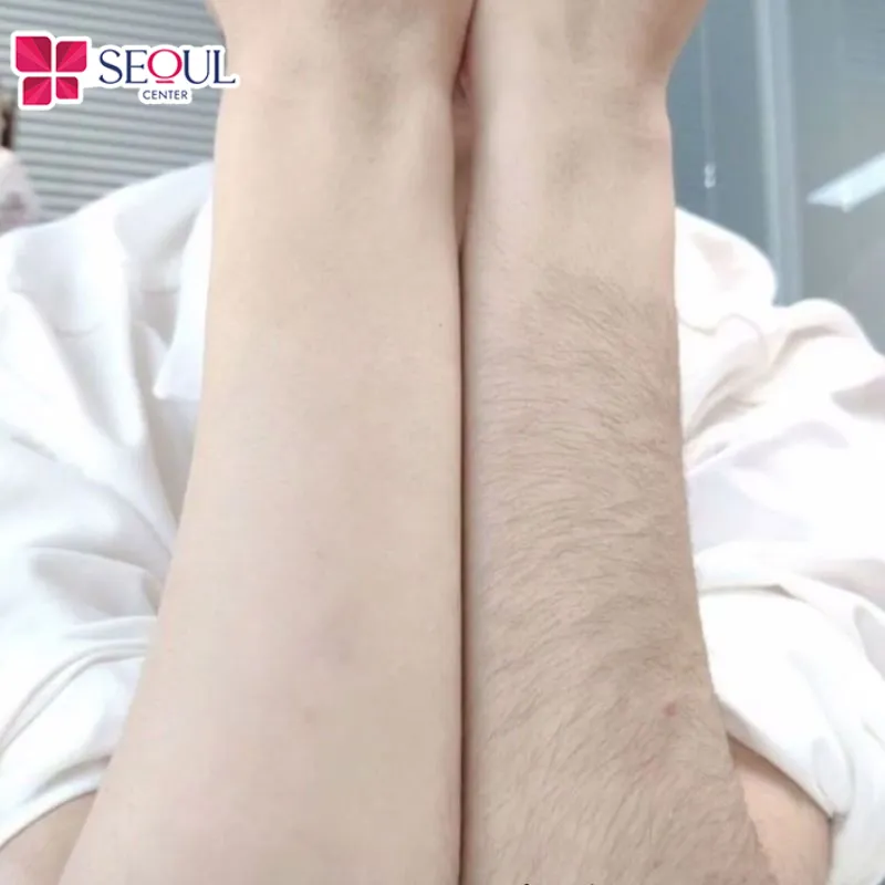 Triệt lông tay sẽ không ảnh hưởng đến sức khỏe như có mất lộc hay không phụ thuộc nhiều vào quan niệm mỗi người