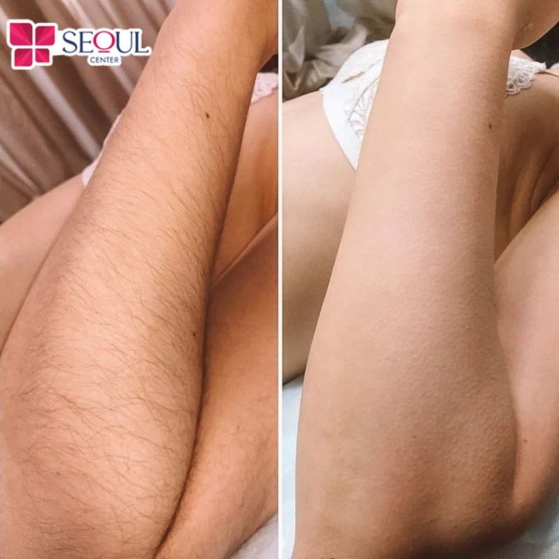 Khách hàng sau khi đến thực hiện triệt lông tay bằng công nghệ hiện đại tại Thẩm mỹ viện Seoul Center