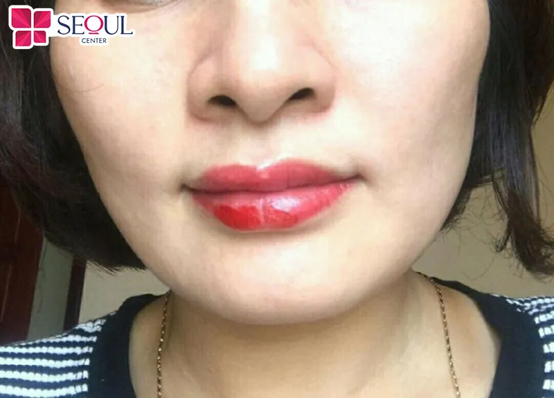 Môi bị khô nứt sau phun là hiện tượng bình thường mà bạn không cần quá lo lắng