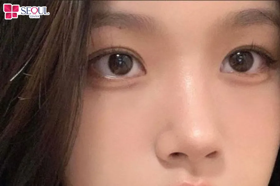 Phun đường mí mắt nai đem lại cho chị em đôi mắt to tròn, long lanh