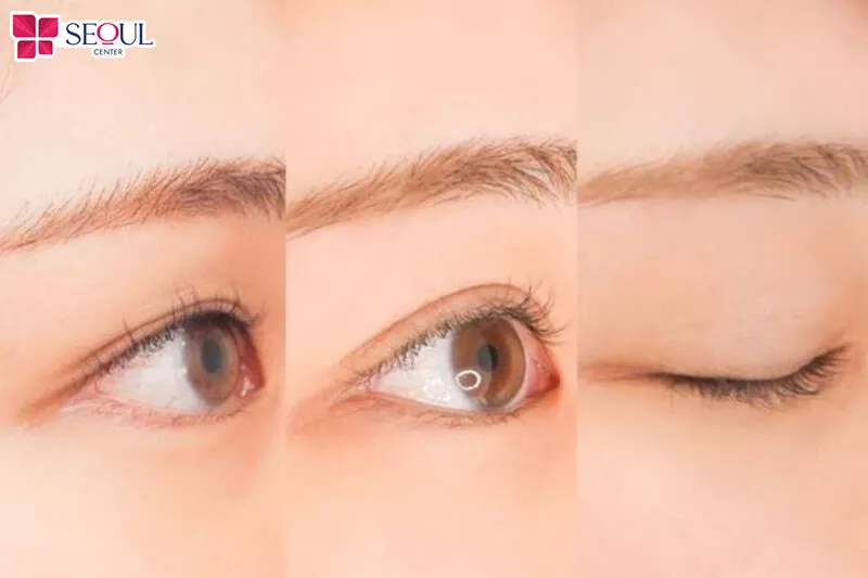 Chi phí thực hiện phun mí mắt nai trên thị trường dao động từ 500.000 - 2.000.000 đồng