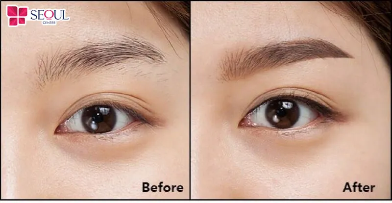 Các bước phun đường mí mắt nai phải thực hiện đúng chuẩn y khoa để đảm bảo an toàn cho khách hàng