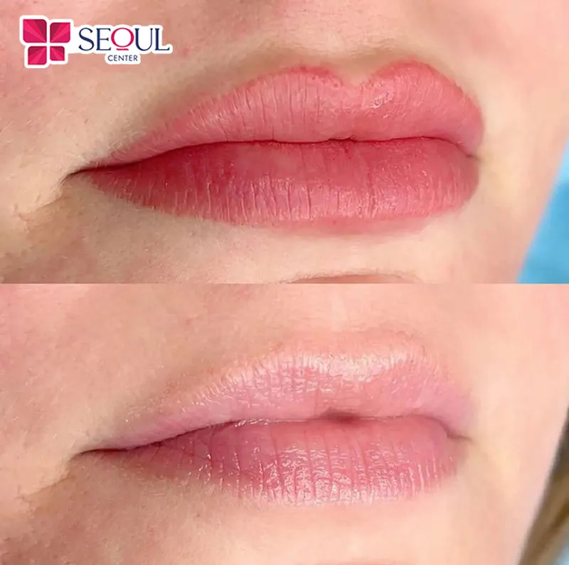 Hình ảnh khách hàng xóa viền môi tại Thẩm mỹ viện Seoul Center