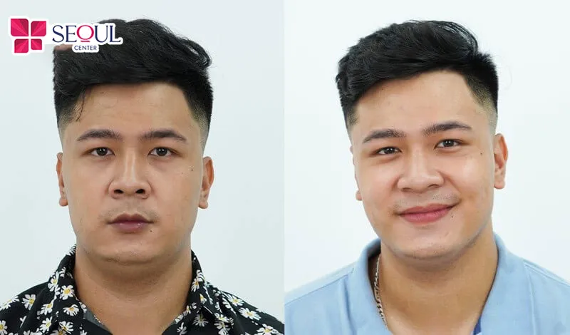 Thần sắc trông tươi tắn hơn sau khi thực hiện phun môi nam giới