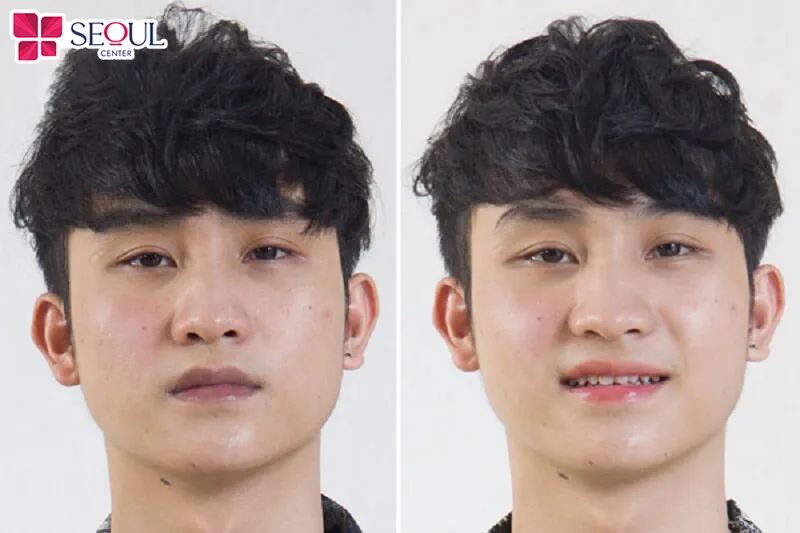 Diện mạo thay đổi hoàn toàn sau phun môi nam giúp đấng mày râu tự tin hơn