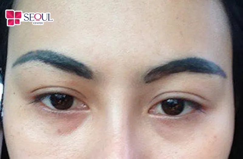 Tác hại của xăm chân mày khiến vùng da trở nên trổ xanh, trổ đỏ sau một thời gian nếu thực hiện tại cơ sở kém uy tín, sử dụng mực phun kém chất lượng