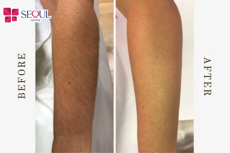 Trước và sau khi khách hàng đến thực hiện triệt lông bằng công nghệ triệt hiện đại