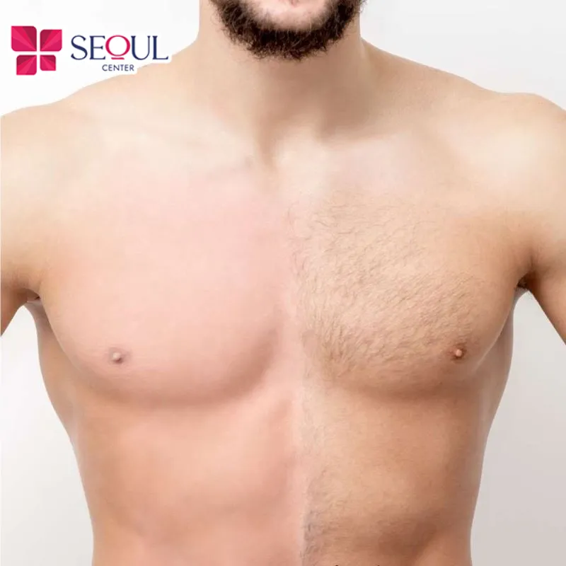 Do yếu tố di truyền hoặc qua độ tuổi dậy thì, vùng da ngực có thể xuất hiện tình trạng rậm lông