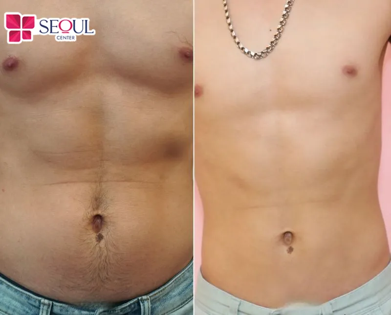 Kỹ thuật viên sẽ triệt lông vùng ngực giúp loại bỏ các sợi lông mọc, mang lại vùng da ngực sạch sẽ, gọn gàng